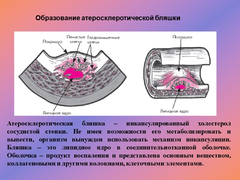 Образование атеросклеротической бляшки  Атеросклеротическая бляшка – инкапсулированный холестерол сосудистой стенки. Не имея возможности